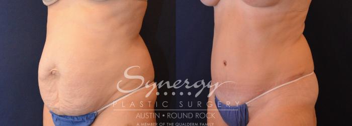 Before & After Abdominoplasty (Tummy Tuck) Case 630 View #2 View in Austin, TX