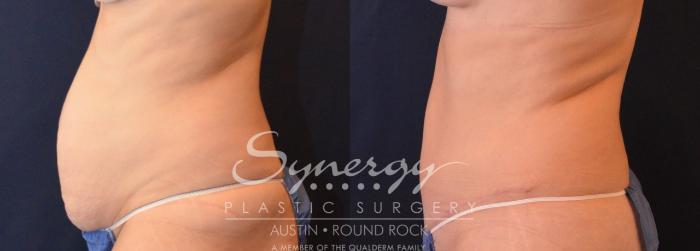 Before & After Abdominoplasty (Tummy Tuck) Case 630 View #3 View in Austin, TX