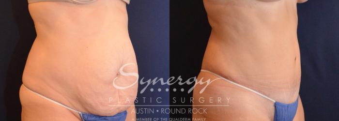 Before & After Abdominoplasty (Tummy Tuck) Case 630 View #4 View in Austin, TX