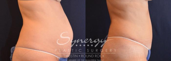 Before & After Abdominoplasty (Tummy Tuck) Case 630 View #5 View in Austin, TX
