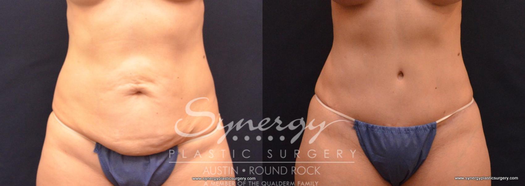 Before & After Abdominoplasty (Tummy Tuck) Case 661 View #1 View in Austin, TX