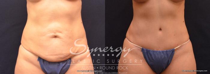 Before & After Abdominoplasty (Tummy Tuck) Case 661 View #1 View in Austin, TX