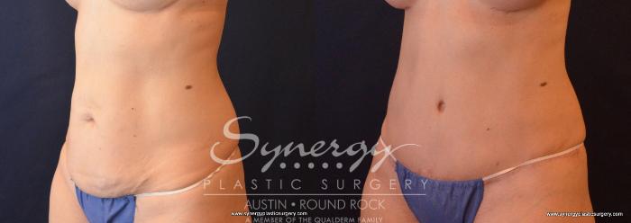 Before & After Abdominoplasty (Tummy Tuck) Case 661 View #2 View in Austin, TX