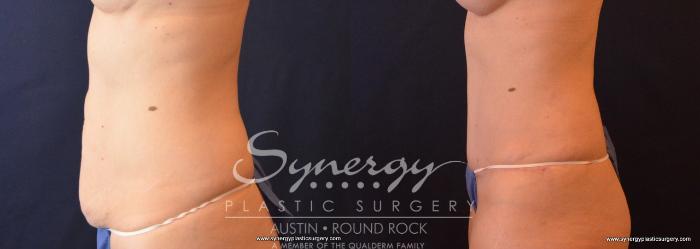 Before & After Abdominoplasty (Tummy Tuck) Case 661 View #3 View in Austin, TX