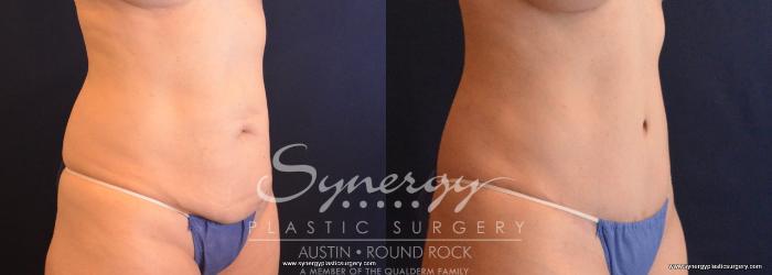 Before & After Abdominoplasty (Tummy Tuck) Case 661 View #4 View in Austin, TX