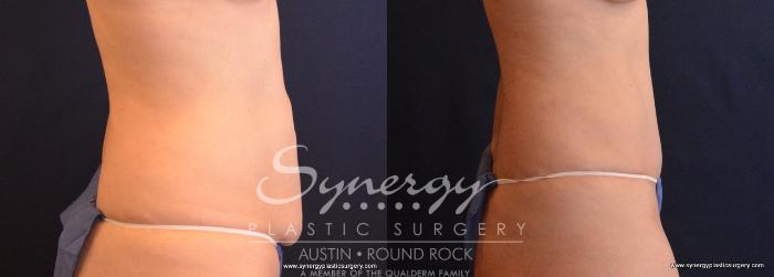 Before & After Abdominoplasty (Tummy Tuck) Case 661 View #5 View in Austin, TX