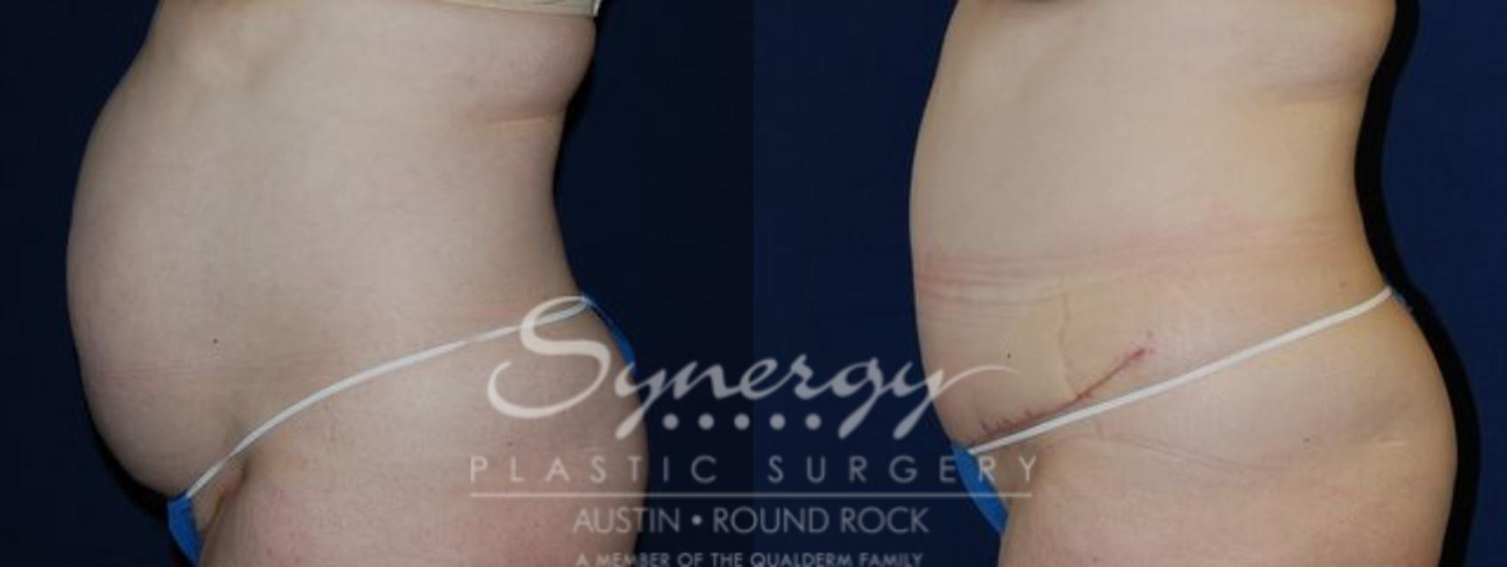 Before & After Abdominoplasty (Tummy Tuck) Case 67 View #1 View in Austin, TX