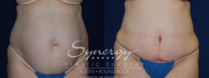 Before & After Abdominoplasty (Tummy Tuck) Case 67 View #2 View in Austin, TX