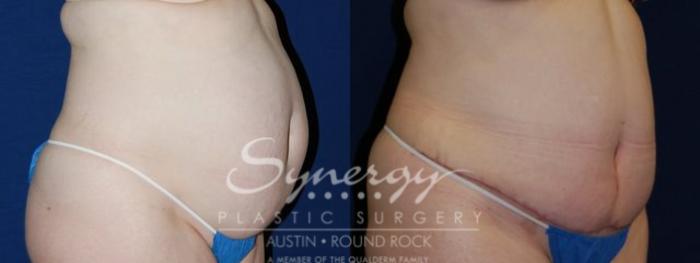 Before & After Abdominoplasty (Tummy Tuck) Case 67 View #3 View in Austin, TX