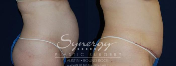 Before & After Abdominoplasty (Tummy Tuck) Case 67 View #4 View in Austin, TX