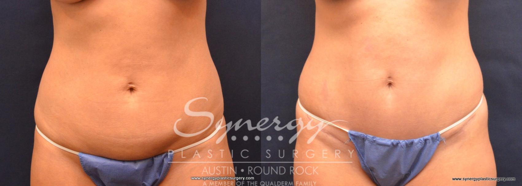 Before & After Abdominoplasty (Tummy Tuck) Case 682 View #1 View in Austin, TX