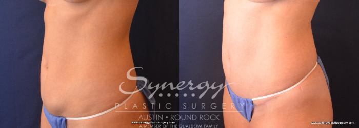Before & After Abdominoplasty (Tummy Tuck) Case 682 View #2 View in Austin, TX