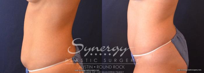 Before & After Abdominoplasty (Tummy Tuck) Case 682 View #3 View in Austin, TX