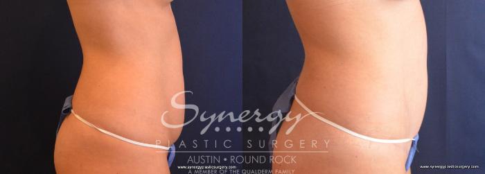 Before & After Abdominoplasty (Tummy Tuck) Case 682 View #4 View in Austin, TX