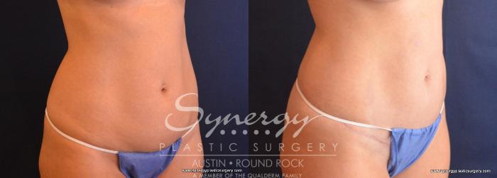 Before & After Abdominoplasty (Tummy Tuck) Case 682 View #5 View in Austin, TX