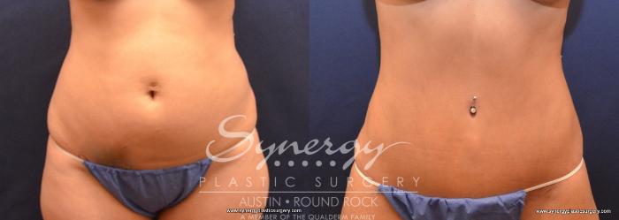 Before & After Abdominoplasty (Tummy Tuck) Case 698 View #1 View in Austin, TX
