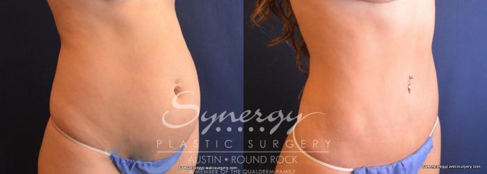 Before & After Abdominoplasty (Tummy Tuck) Case 698 View #2 View in Austin, TX