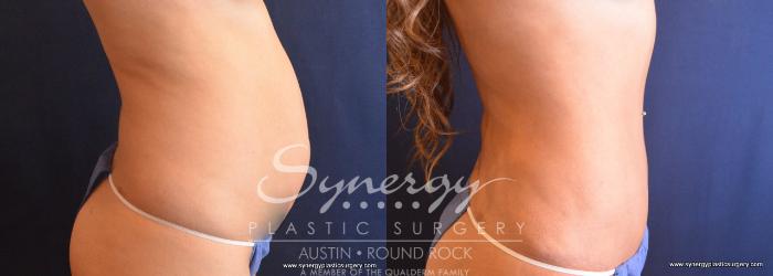 Before & After Abdominoplasty (Tummy Tuck) Case 698 View #3 View in Austin, TX