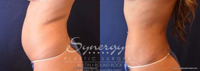 Before & After Abdominoplasty (Tummy Tuck) Case 698 View #4 View in Austin, TX