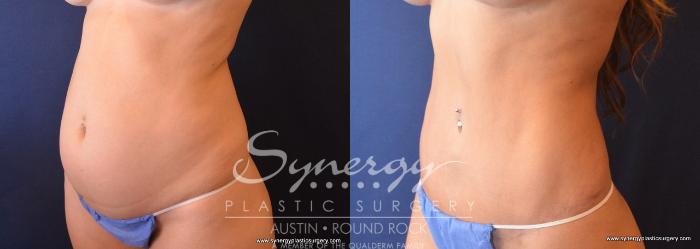 Before & After Abdominoplasty (Tummy Tuck) Case 698 View #5 View in Austin, TX