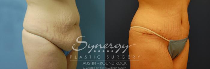 Before & After Abdominoplasty (Tummy Tuck) Case 7 View #1 View in Austin, TX