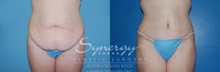 Before & After Abdominoplasty (Tummy Tuck) Case 7 View #2 View in Austin, TX