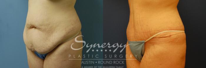 Before & After Abdominoplasty (Tummy Tuck) Case 7 View #3 View in Austin, TX