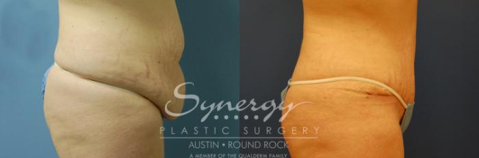Before & After Abdominoplasty (Tummy Tuck) Case 7 View #4 View in Austin, TX