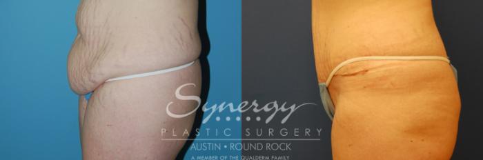 Before & After Abdominoplasty (Tummy Tuck) Case 7 View #5 View in Austin, TX
