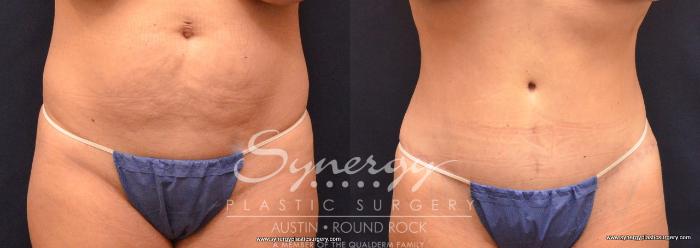 Before & After Abdominoplasty (Tummy Tuck) Case 702 View #1 View in Austin, TX