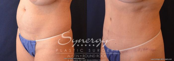 Before & After Abdominoplasty (Tummy Tuck) Case 702 View #2 View in Austin, TX