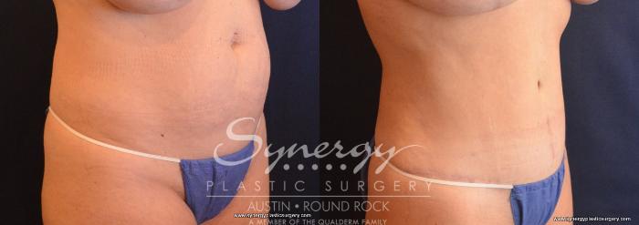 Before & After Abdominoplasty (Tummy Tuck) Case 702 View #3 View in Austin, TX