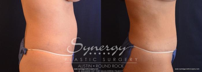 Before & After Abdominoplasty (Tummy Tuck) Case 702 View #4 View in Austin, TX