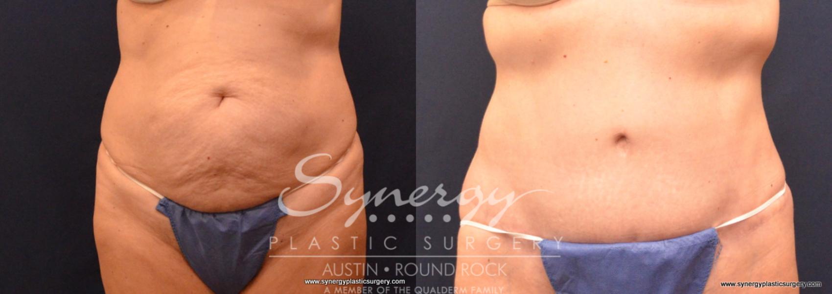 Before & After Abdominoplasty (Tummy Tuck) Case 706 View #1 View in Austin, TX