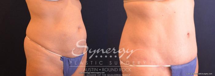 Before & After Abdominoplasty (Tummy Tuck) Case 706 View #2 View in Austin, TX