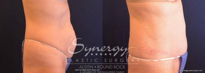 Before & After Abdominoplasty (Tummy Tuck) Case 706 View #3 View in Austin, TX