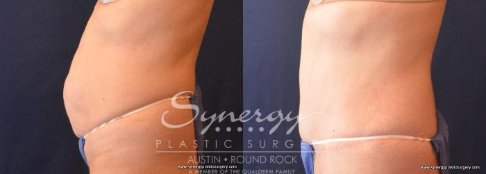 Before & After Abdominoplasty (Tummy Tuck) Case 706 View #4 View in Austin, TX