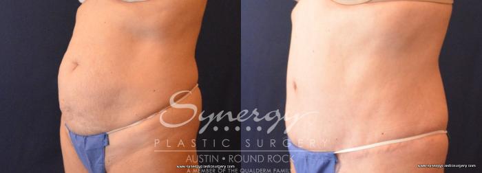 Before & After Abdominoplasty (Tummy Tuck) Case 706 View #5 View in Austin, TX