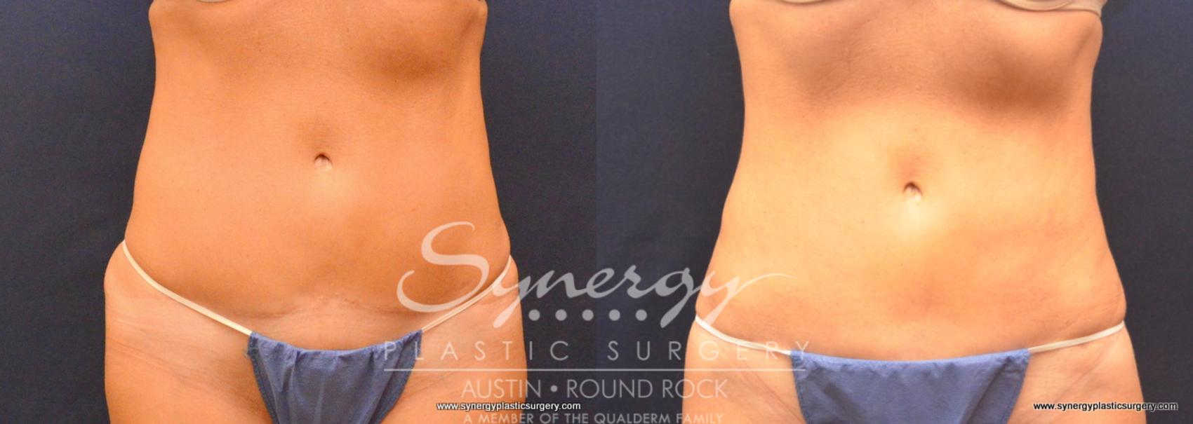 Before & After Abdominoplasty (Tummy Tuck) Case 707 View #1 View in Austin, TX