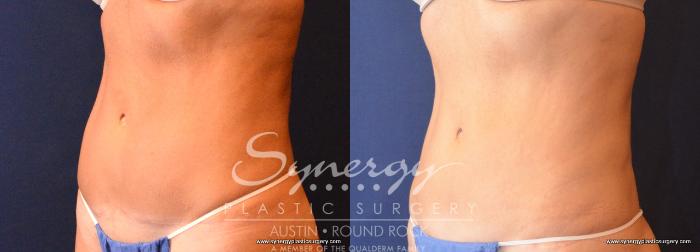 Before & After Abdominoplasty (Tummy Tuck) Case 707 View #2 View in Austin, TX