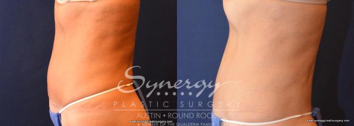 Before & After Abdominoplasty (Tummy Tuck) Case 707 View #3 View in Austin, TX