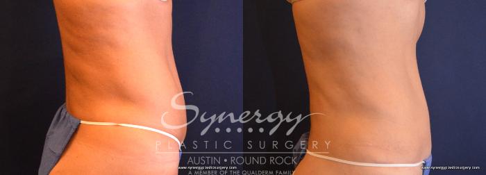 Before & After Abdominoplasty (Tummy Tuck) Case 707 View #4 View in Austin, TX