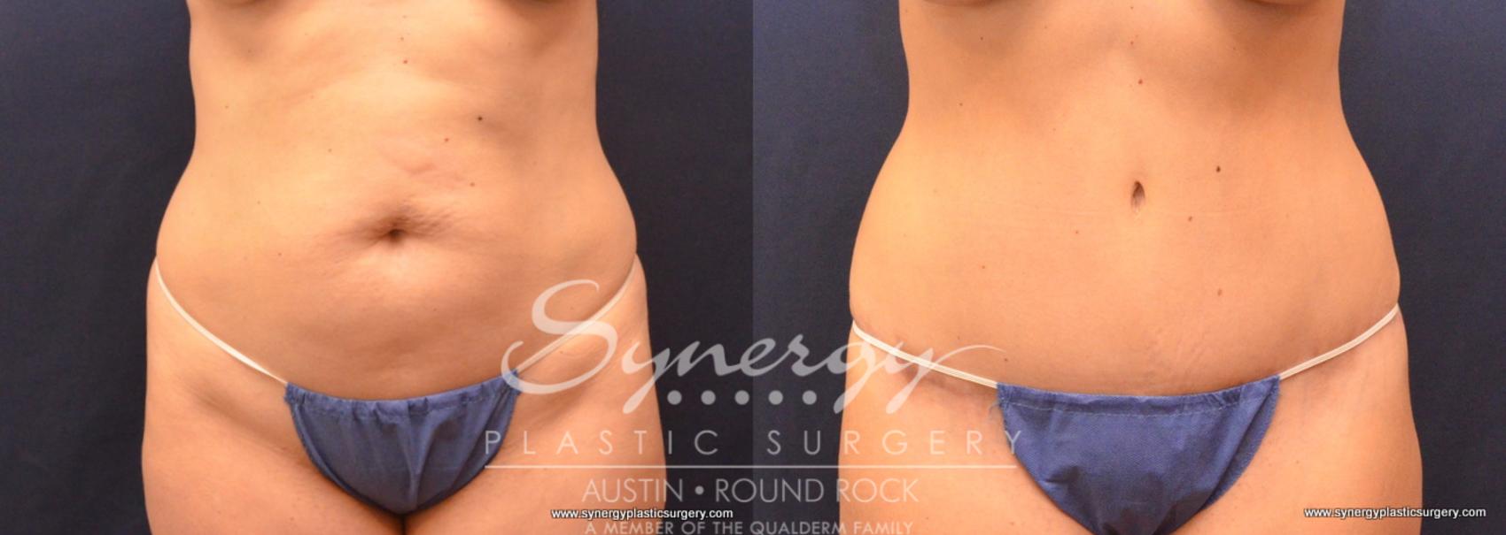 Before & After Abdominoplasty (Tummy Tuck) Case 721 View #1 View in Austin, TX