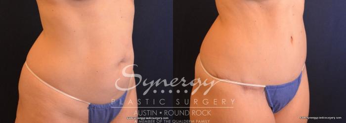 Before & After Abdominoplasty (Tummy Tuck) Case 721 View #2 View in Austin, TX