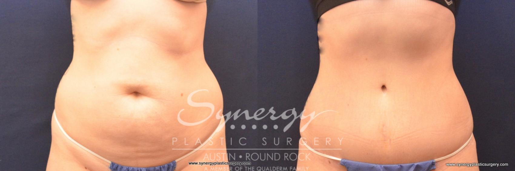 Before & After Abdominoplasty (Tummy Tuck) Case 789 View #1 View in Austin, TX
