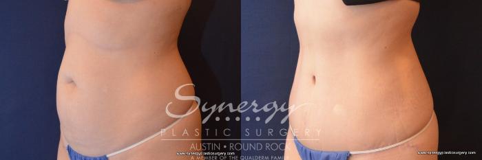 Before & After Abdominoplasty (Tummy Tuck) Case 789 View #2 View in Austin, TX