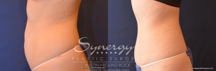 Before & After Abdominoplasty (Tummy Tuck) Case 789 View #3 View in Austin, TX