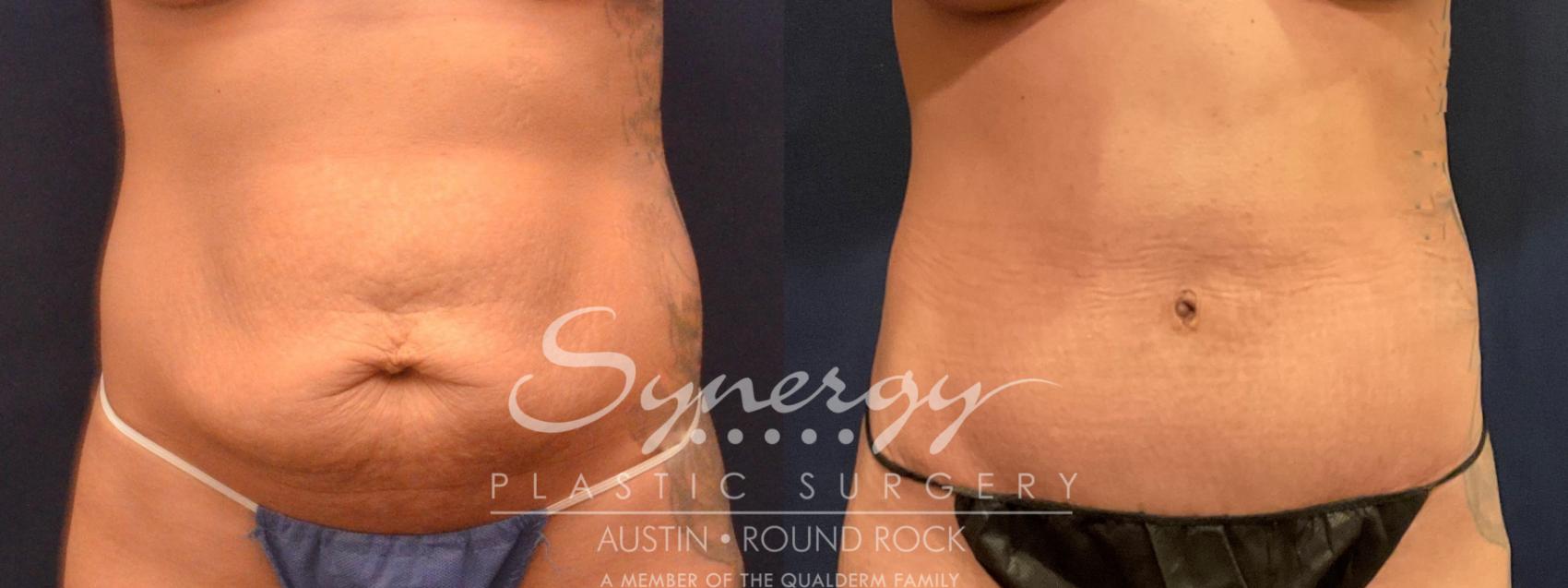 abdominoplasty, synergy plastic surgery 