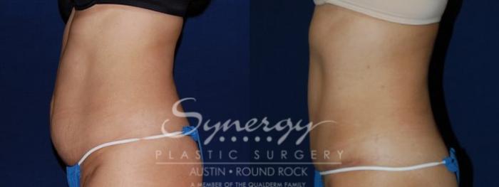 Before & After Abdominoplasty (Tummy Tuck) Case 81 View #1 View in Austin, TX