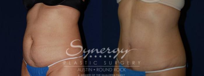 Before & After Abdominoplasty (Tummy Tuck) Case 81 View #2 View in Austin, TX